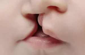 Read more about the article New classification system for nasal deformity in cleft lip and palate reported