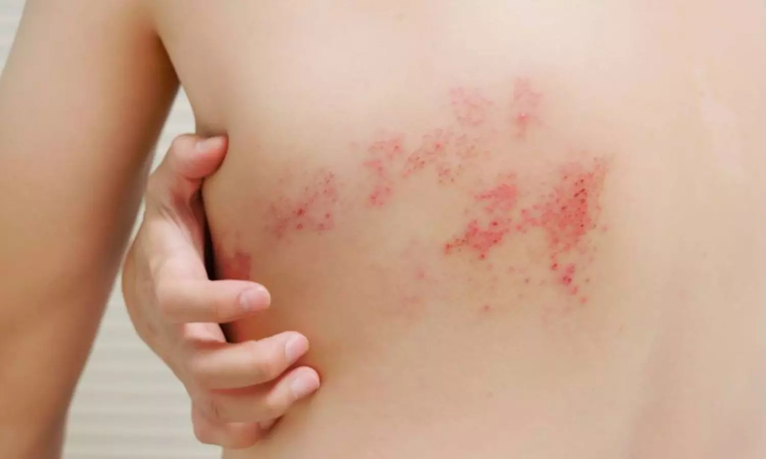 Read more about the article Individuals with cataract at increased risk of developing herpes zoster: Study