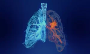 Read more about the article Talc or Minocycline Pleurodesis May Aid managing malignant pleural effusion Management in Lung Cancer with ILD: Study