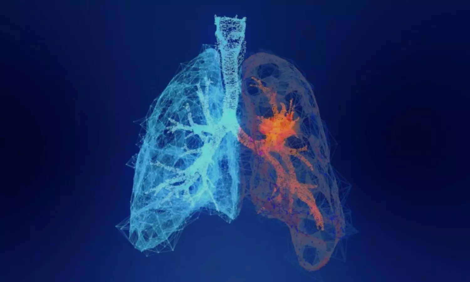 You are currently viewing Talc or Minocycline Pleurodesis May Aid managing malignant pleural effusion Management in Lung Cancer with ILD: Study