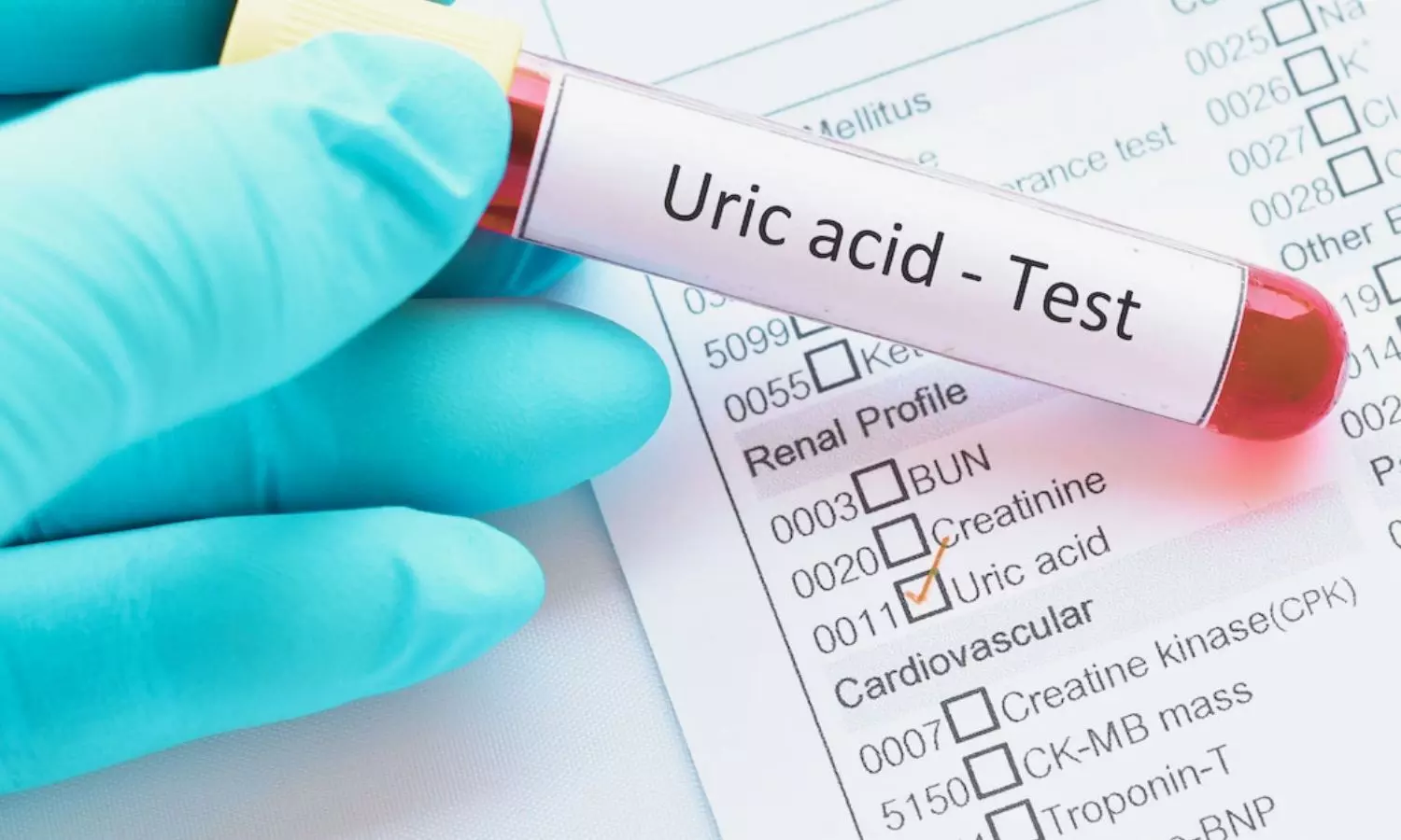 You are currently viewing Higher long-term variability of serum uric acid associated with diabetic retinopathy risk: Study