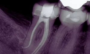 Read more about the article Non-Surgical Root Canal Resolves Rare Mandibular Molar Malformation in Teenager: Case Report