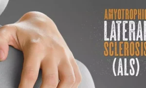 Read more about the article Psychiatric Medications Linked to Higher ALS Risk and Poorer Prognosis: JAMA