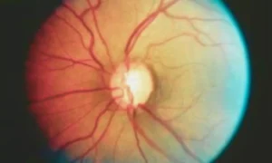 Read more about the article Obstructive Sleep Apnea Doubles Risk of Severe Glaucoma Progression, Study Finds