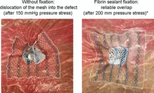 Read more about the article Positive-Pressure Exhaust Technique Improves Mesh Fixation in TAPP Hernia Repair: Study