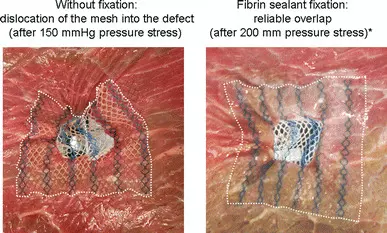 Read more about the article Positive-Pressure Exhaust Technique Improves Mesh Fixation in TAPP Hernia Repair: Study