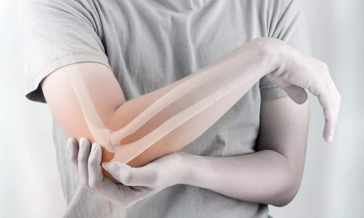 Read more about the article Casting Alone Proven as Effective as Surgery for Displaced Pediatric Elbow Fractures: Study