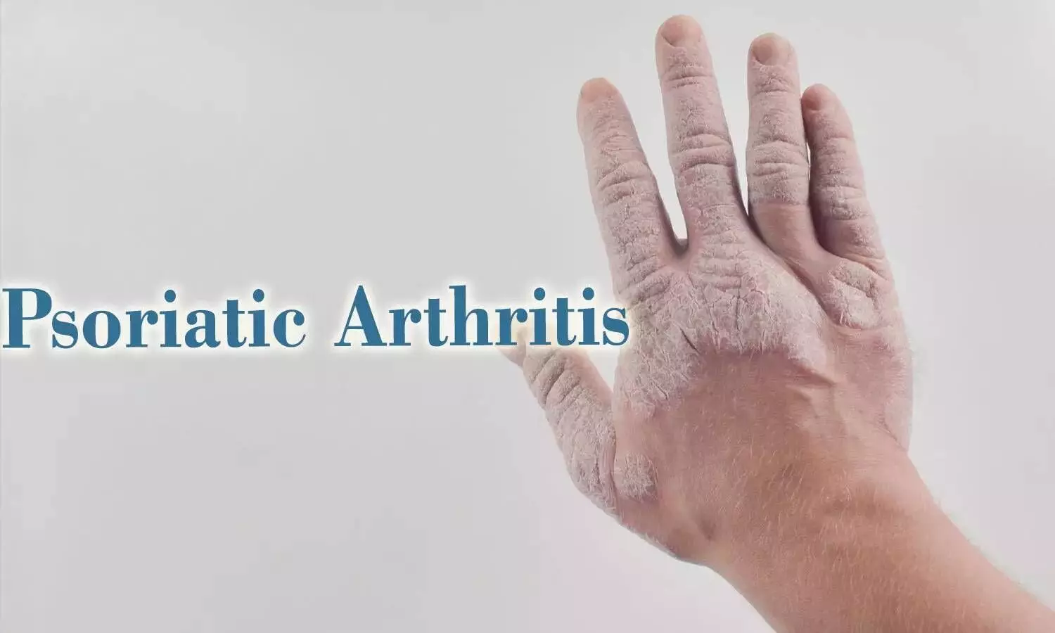 You are currently viewing Metabolic Syndrome in Psoriatic Arthritis Linked to Degenerative Spine and heel issues: Study