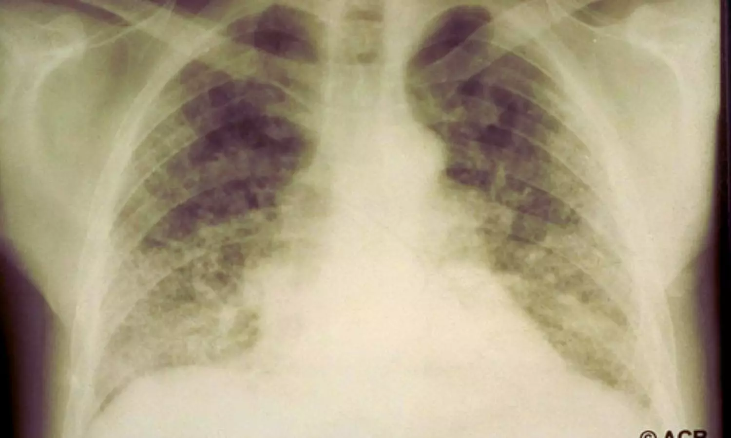 You are currently viewing Rheumatoid Arthritis-Linked Lung Disease Significantly Raises Risk of Death, Finds Study