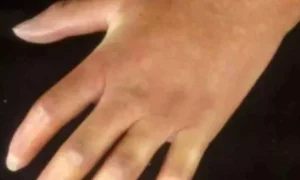 Read more about the article Early ILD Progression in Systemic Sclerosis Linked to Higher Mortality, Not Continued Lung Decline: Study Suggests