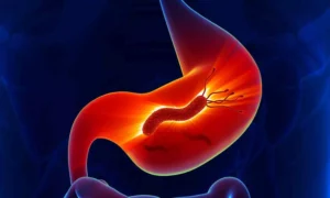 Read more about the article Long-Term H. pylori Eradication Effectively Reduces Gastric Cancer Risk: Nature