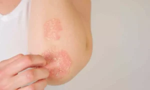 Read more about the article Guselkumab Effective and Long-Lasting Psoriasis Treatment Across All Skin Tones, suggests study