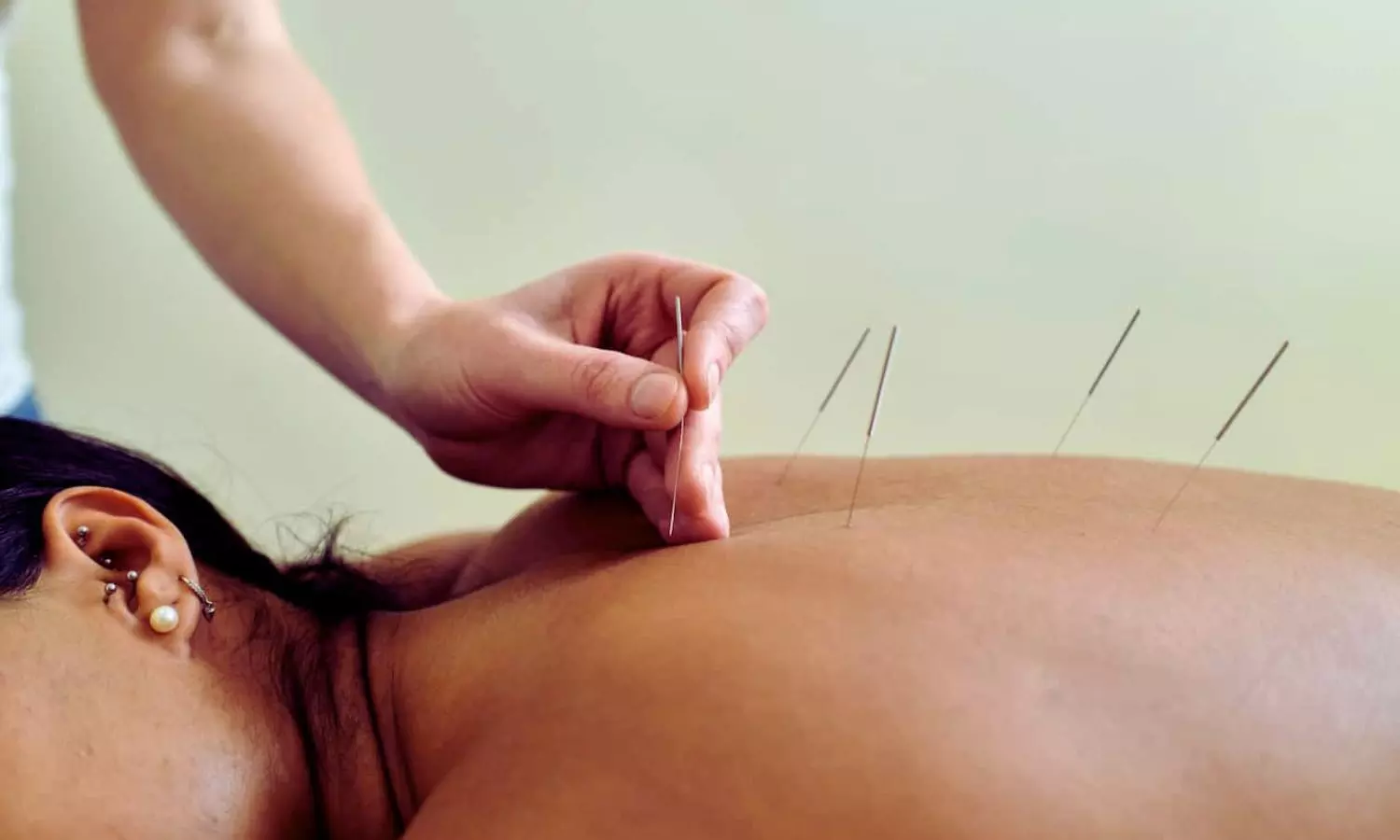 You are currently viewing Warm Acupuncture Eases Fibromyalgia Symptoms Linked to Cold Sensitivity: Study