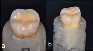 Read more about the article Immediate Dentin Sealing may  Improve Adhesion and Restoration Durability in both healthy and eroded dentin: Study