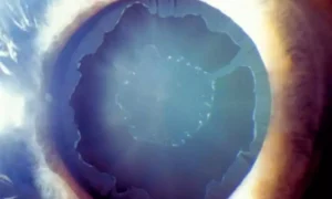 Read more about the article Pseudoexfoliation Syndrome May Predict Glaucoma via Ganglion Cell Layer Thinning: Study