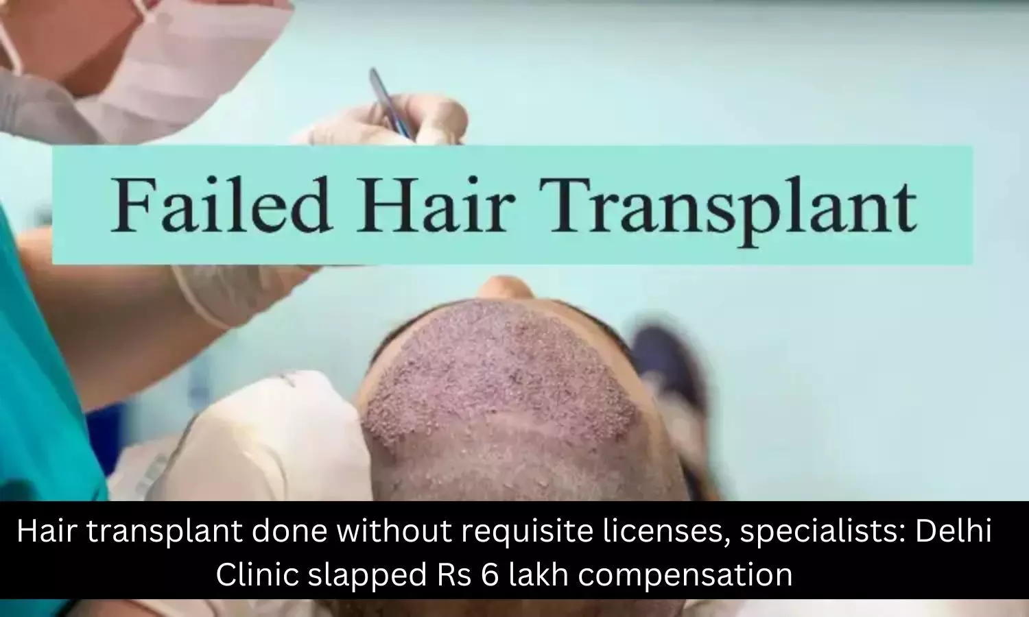 You are currently viewing Hair transplant done without requisite licenses, specialists: Delhi Clinic ordered to pay Rs 6 lakh compensation