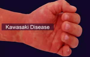 Read more about the article Patients with Kawasaki disease have increased risk of allergic diseases: BMC