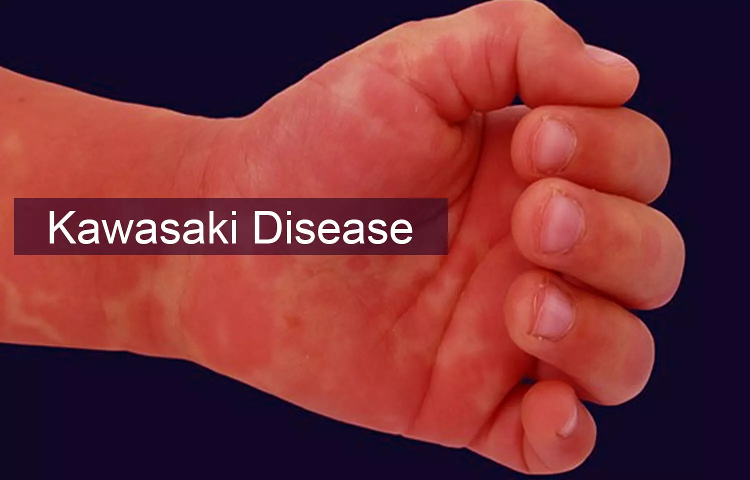 Read more about the article Patients with Kawasaki disease have increased risk of allergic diseases: BMC