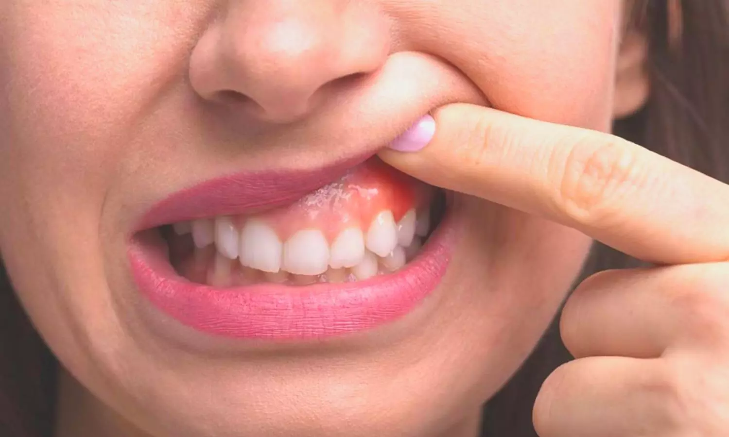 You are currently viewing Severe Gum Disease Strongly Linked to Chronic Illnesses, Large U.S. Study Finds