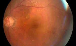 Read more about the article Red Cell Distribution Width-to-Albumin Ratio Shows Nonlinear Link With Retinopathy Risk: Study