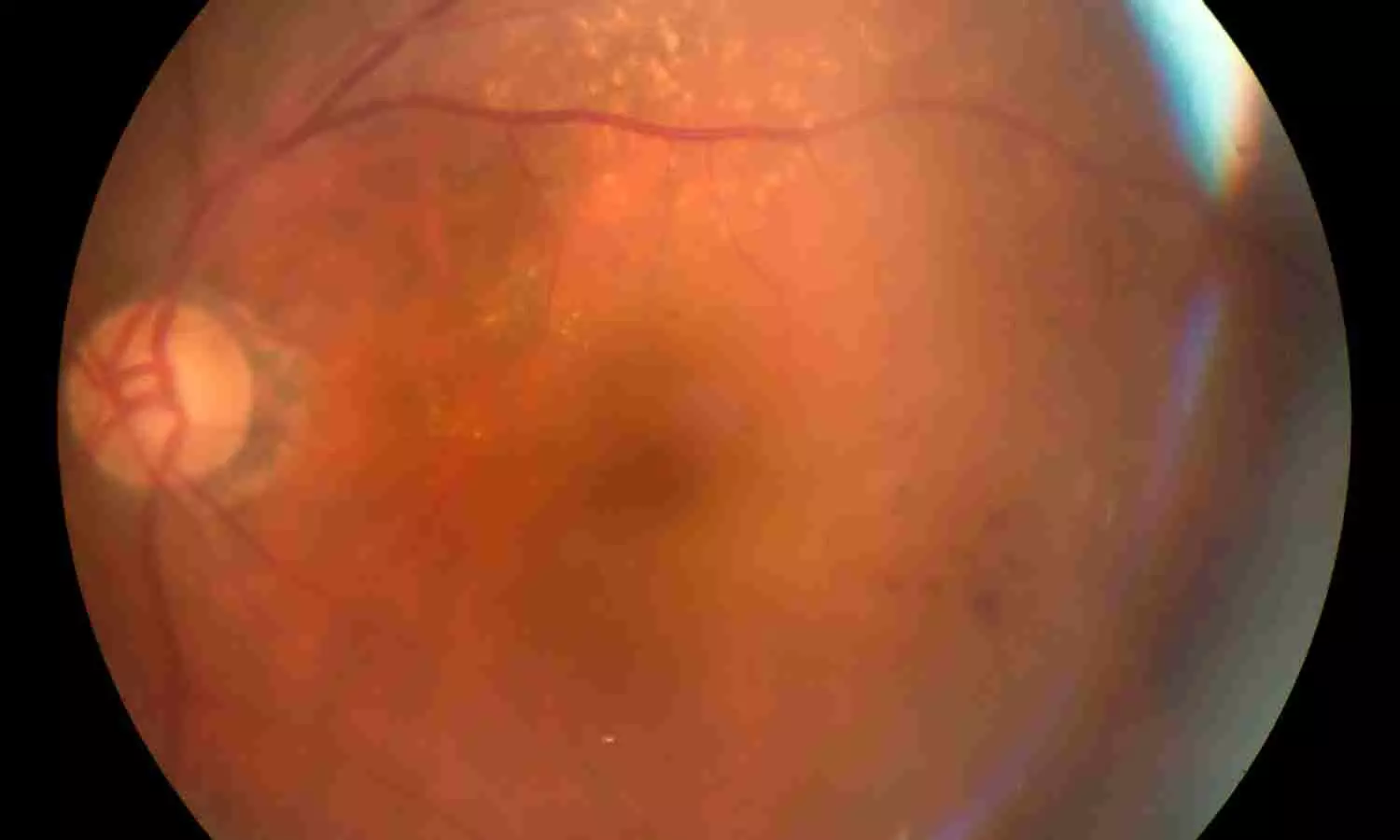Red Cell Distribution Width-to-Albumin Ratio Shows Nonlinear Link With Retinopathy Risk: Study