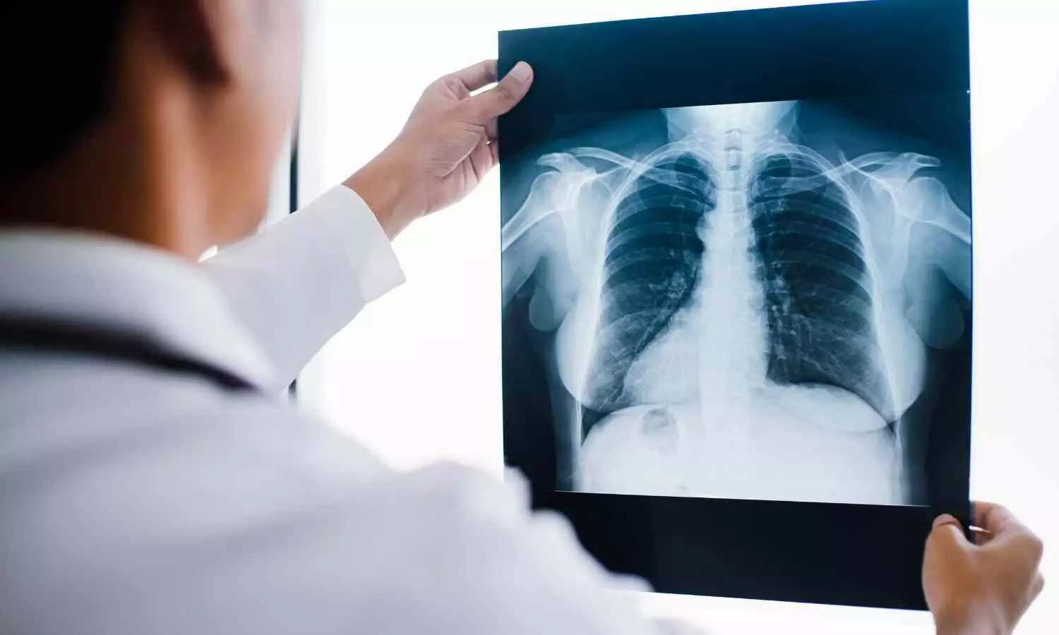 You are currently viewing AI based chest CT images accurate in predicting lung function of COPD patients: Study