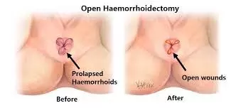 You are currently viewing Metronidazole effectively reduces  pain in patients after hemorrhoidectomy: Study
