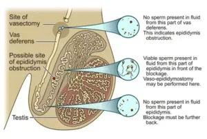 Read more about the article Intra-operative measurements of testicular vasal lumen diameter can be an adjunctive factor that may influence choice of VR technique: Study