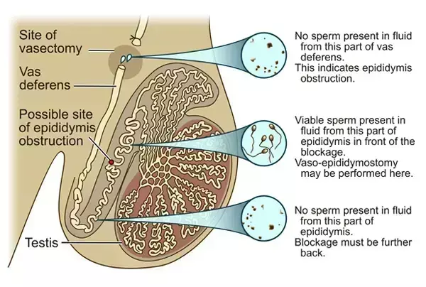 You are currently viewing Intra-operative measurements of testicular vasal lumen diameter can be an adjunctive factor that may influence choice of VR technique: Study