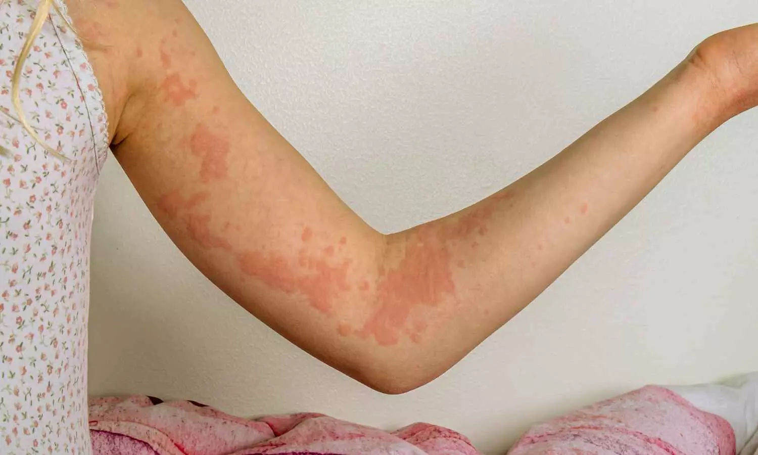 Read more about the article Chronic hives: Researchers identify most effective, safest treatments