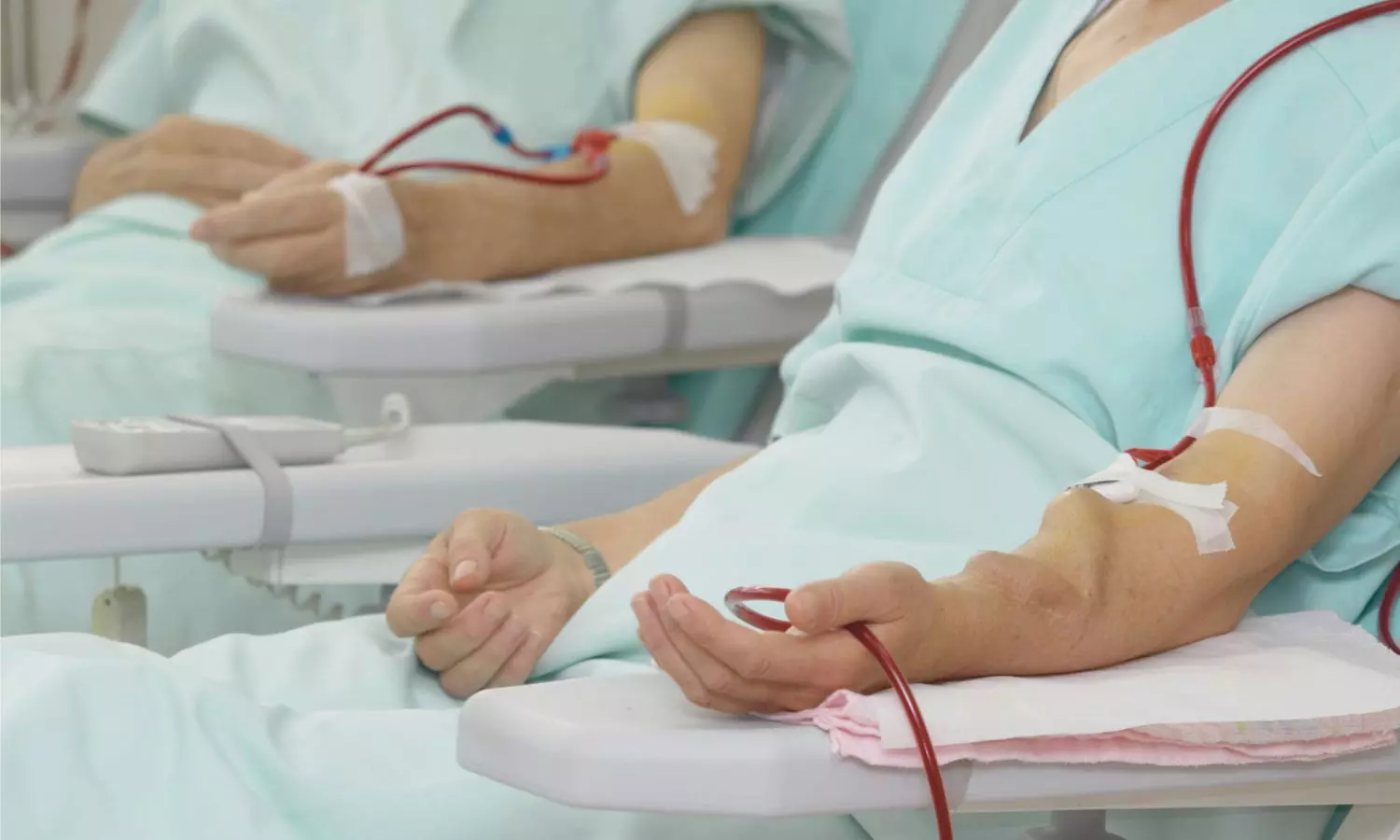 You are currently viewing Chlorhexidine Outperforms Ethanol in Preventing AVF Infections During Buttonhole Cannulation: Trial Finds