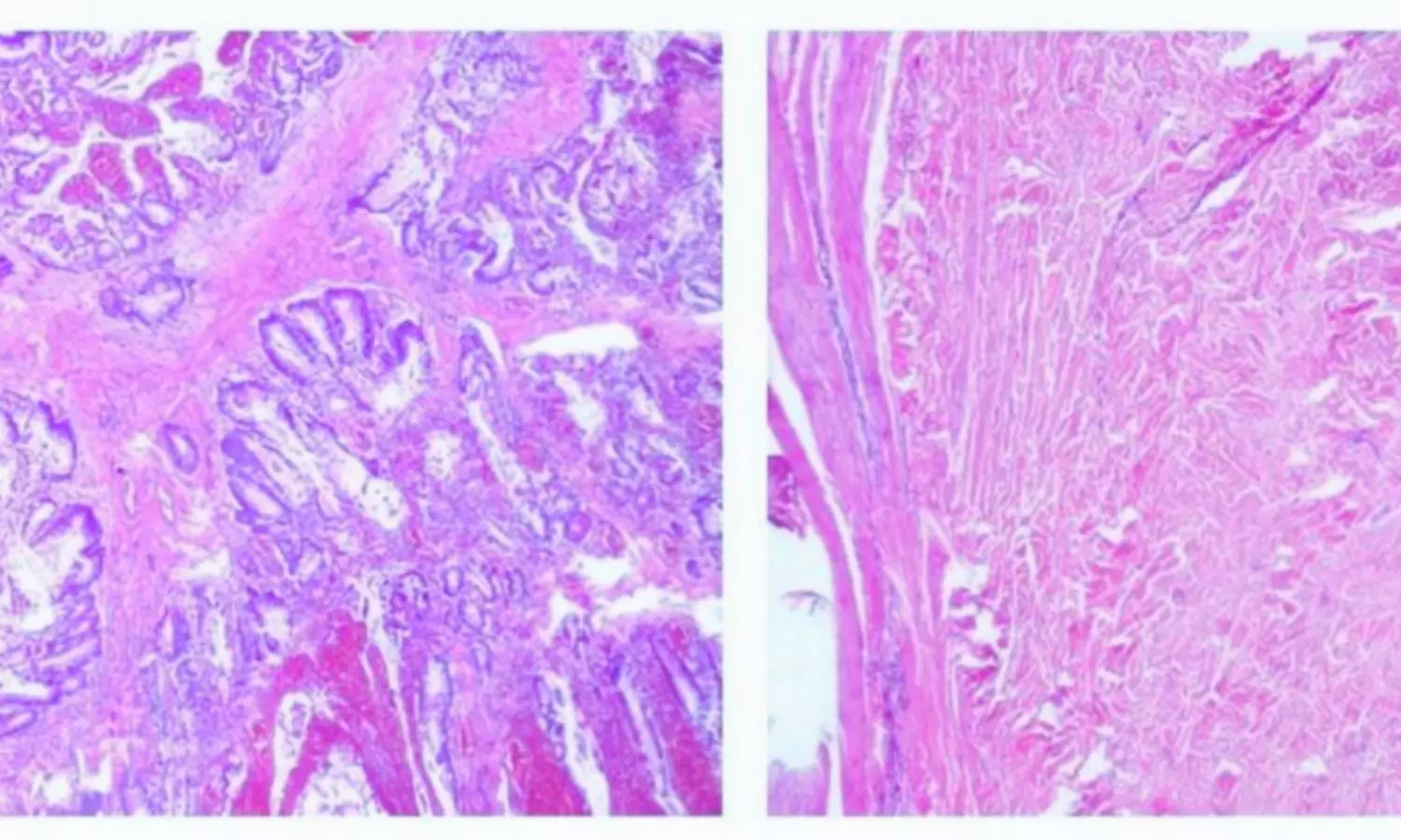 You are currently viewing Rare Case Links Peutz-Jeghers Syndrome to Kidney Anomaly, Suggests Broader Screening and STK11 Role