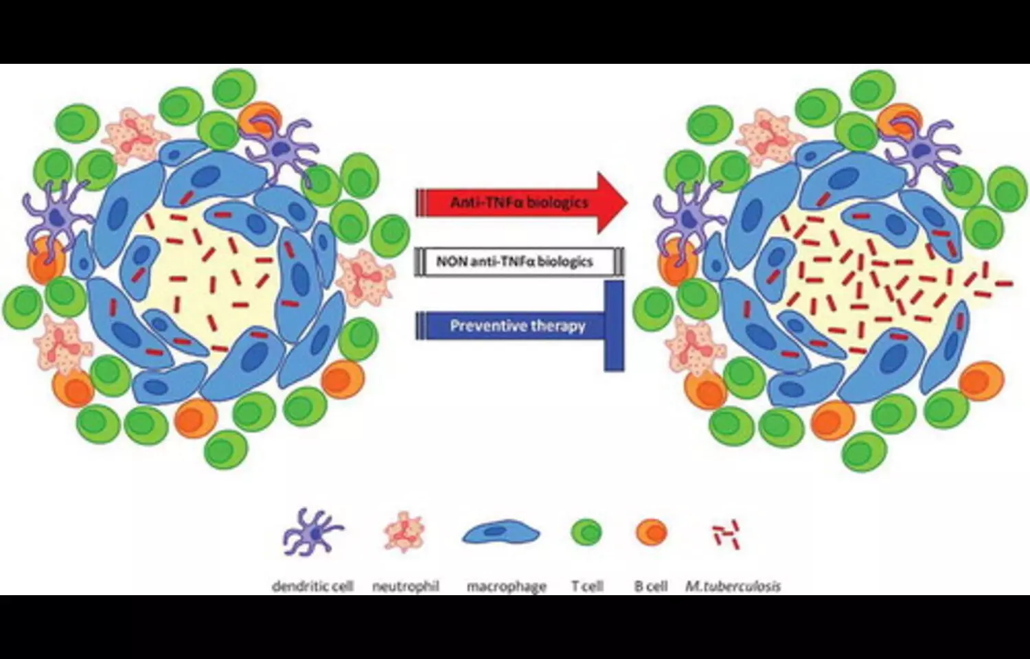 You are currently viewing Increased TB Risk in Psoriasis Patients on Etanercept Despite Isoniazid Prophylaxis: Study