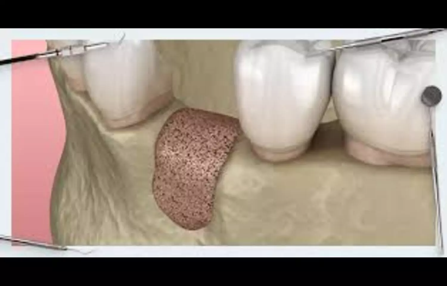 Read more about the article Add on Collagen Membranes over titanium meshes not necessary in GBR-Based VRA: Study