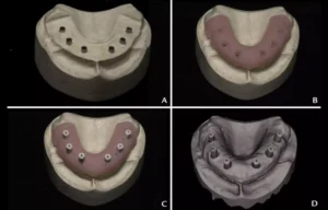 Read more about the article Longer Edentulous Spans Reduce Scanner Accuracy in Full-Arch Digital Workflows: Study