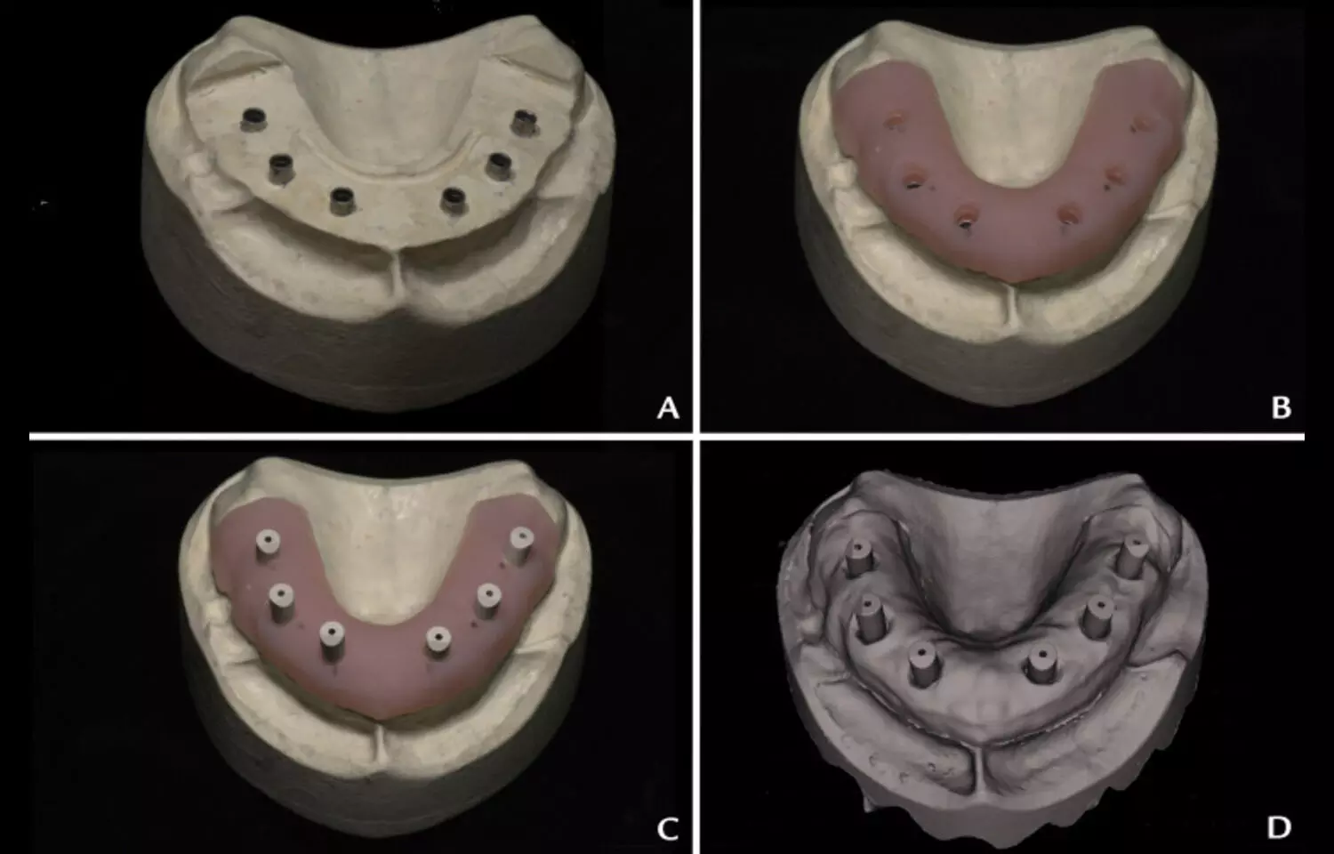 You are currently viewing Longer Edentulous Spans Reduce Scanner Accuracy in Full-Arch Digital Workflows: Study