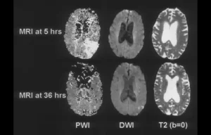 Read more about the article Alteplase May Improve Outcomes When Given 4.5–24 Hours After Stroke in Select Patients: JAMA