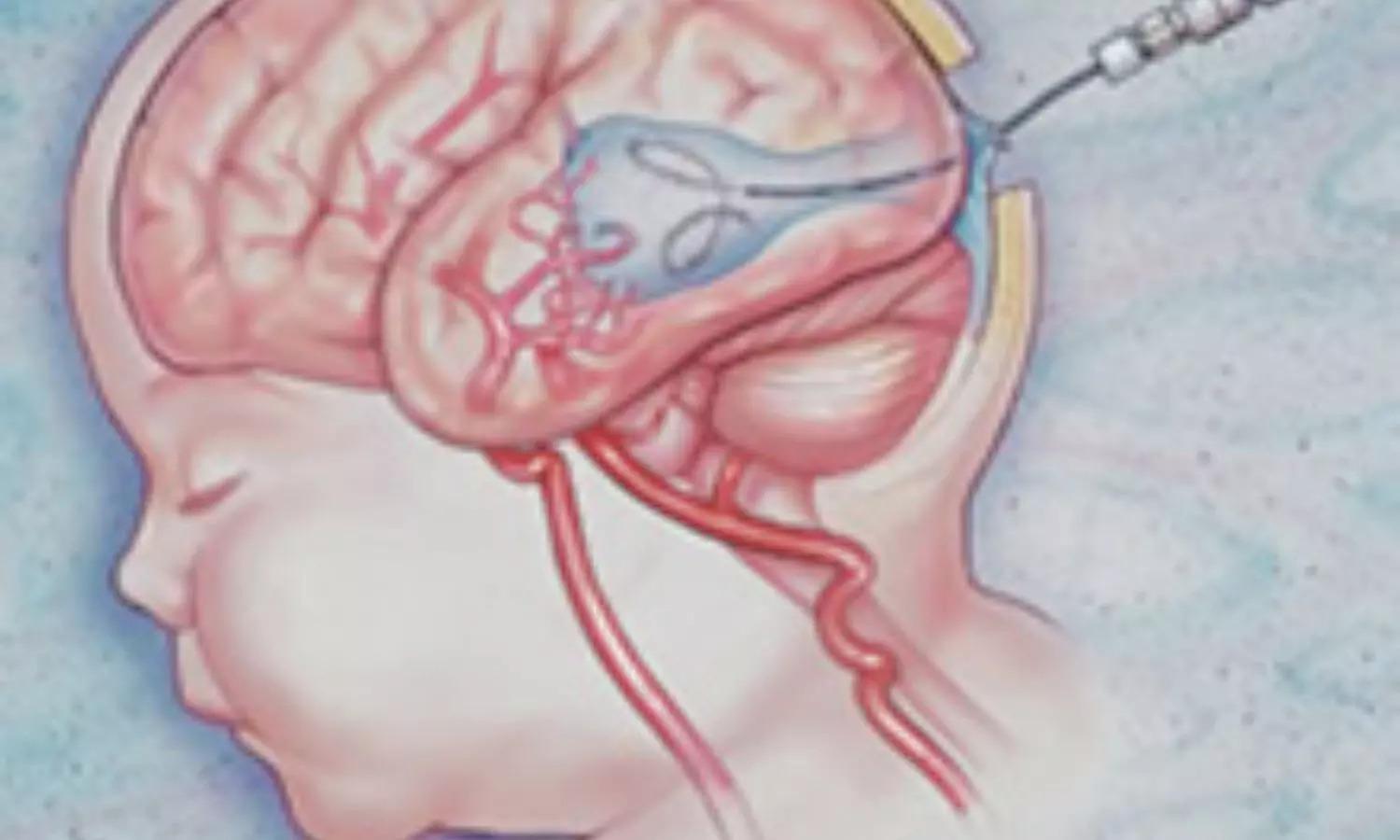 Read more about the article Fetal Embolization Exhibits Early Success in High-Risk Vein of Galen Malformation: JAMA