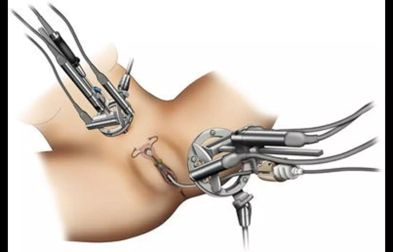 You are currently viewing Uterine Manipulators  may Enhance Laparoscopic Rectal Surgery in Women: Study