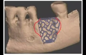 Read more about the article 0.3 mm thick Titanium Mesh Found Most Reliable for Guided Bone Regeneration, suggests study