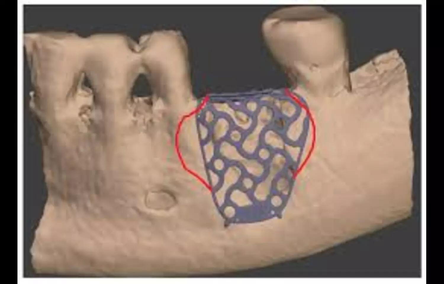 You are currently viewing 0.3 mm thick Titanium Mesh Found Most Reliable for Guided Bone Regeneration, suggests study