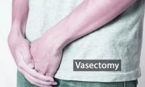 Read more about the article Vasectomy More Cost-Effective Than Salpingectomy for Permanent Contraception, Reveals Research
