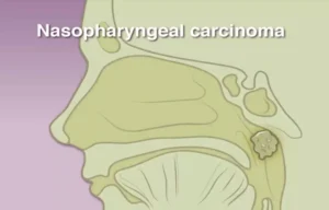 Read more about the article Toripalimab-Based Cisplatin-Free Strategy Efficacious, safe in Advanced NPC: JAMA