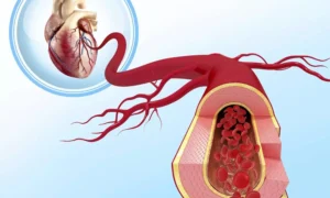 Read more about the article Routine heart CT scanning not warranted after stenting for left main CAD: ESC Study