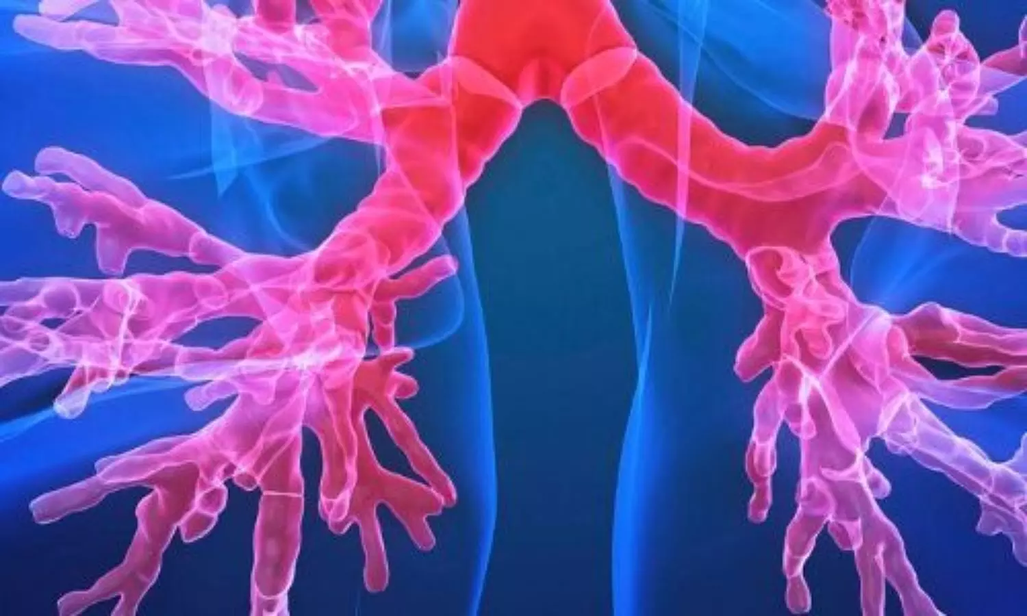 You are currently viewing Symptoms Predict Exacerbation Risk in Bronchiectasis, Suggesting Expanded Role for Macrolide Therapy: Study Finds