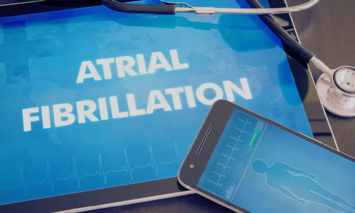 Read more about the article Pulsed field ablation not superior to radiofrequency ablation in paroxysmal atrial fibrillation: ESC Study