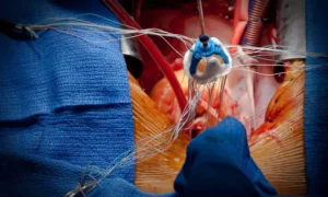 Read more about the article New Study identifies early signs of valve failure one year after TAVI, raising durability concerns in younger patients
