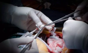 Read more about the article De-escalation of DAPT provides benefits in patients after CABG: ESC Study