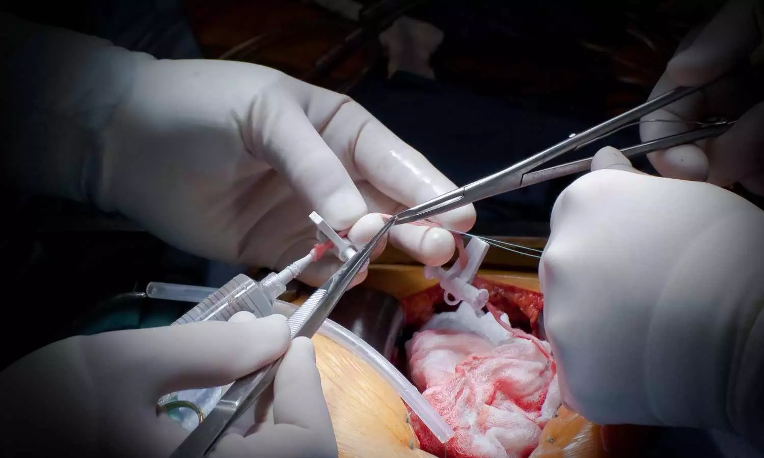 You are currently viewing De-escalation of DAPT provides benefits in patients after CABG: ESC Study