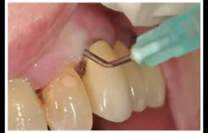 Read more about the article Ozonated Water Shows Modest Benefits in Periodontal Therapy: Study